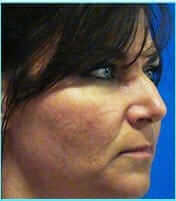 Rhinoplasty Before & After Patient #565