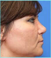 Rhinoplasty Before & After Patient #565