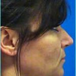 Rhinoplasty Before & After Patient #565