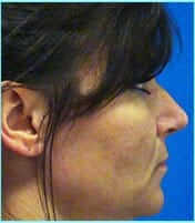 Rhinoplasty Before & After Patient #565