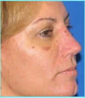 Revision Rhinoplasty Before & After Patient #239