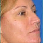 Revision Rhinoplasty Before & After Patient #239