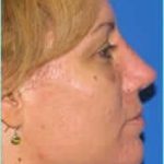 Revision Rhinoplasty Before & After Patient #239