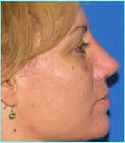 Revision Rhinoplasty Before & After Patient #239