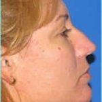 Rhinophyma Before & After Patient #1325