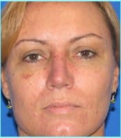 Rhinoplasty Before & After Patient #514