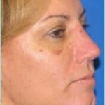 Rhinoplasty Before & After Patient #514