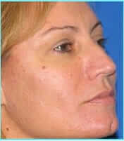 Rhinoplasty Before & After Patient #514