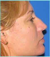 Rhinoplasty Before & After Patient #514