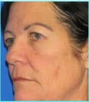 Revision Rhinoplasty Before & After Patient #220