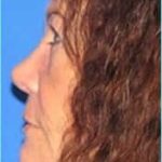 Revision Rhinoplasty Before & After Patient #220