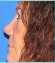 Revision Rhinoplasty Before & After Patient #220