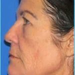 Revision Rhinoplasty Before & After Patient #220