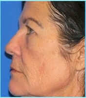 Revision Rhinoplasty Before & After Patient #220