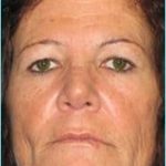 Rhinophyma Before & After Patient #1307