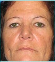 Rhinoplasty Before & After Patient #496