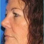 Rhinoplasty Before & After Patient #496