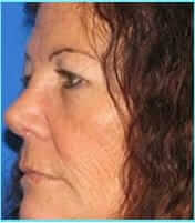 Rhinoplasty Before & After Patient #496