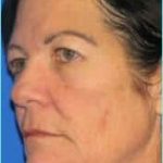 Rhinoplasty Before & After Patient #496