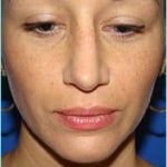Rhinoplasty Before & After Patient #489