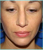 Rhinoplasty Before & After Patient #489