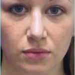 Rhinoplasty Before & After Patient #489