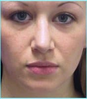 Rhinoplasty Before & After Patient #489