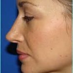 Rhinoplasty Before & After Patient #489