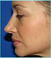Rhinoplasty Before & After Patient #489