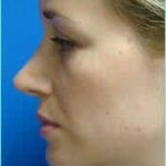 Rhinoplasty Before & After Patient #489