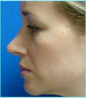 Rhinoplasty Before & After Patient #489