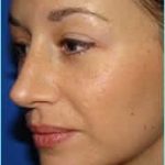 Rhinoplasty Before & After Patient #489