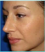 Rhinoplasty Before & After Patient #489
