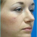 Rhinoplasty Before & After Patient #489