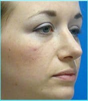 Rhinoplasty Before & After Patient #489