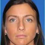 Revision Rhinoplasty Before & After Patient #246