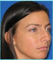 Revision Rhinoplasty Before & After Patient #246