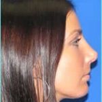 Revision Rhinoplasty Before & After Patient #246