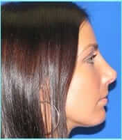Revision Rhinoplasty Before & After Patient #246