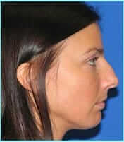 Revision Rhinoplasty Before & After Patient #246