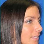 Rhinophyma Before & After Patient #1332