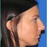 Rhinophyma Before & After Patient #1332
