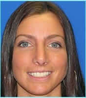 Rhinoplasty Before & After Patient #521