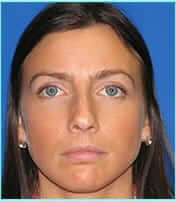 Rhinoplasty Before & After Patient #521