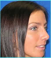 Rhinoplasty Before & After Patient #521