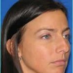 Rhinoplasty Before & After Patient #521
