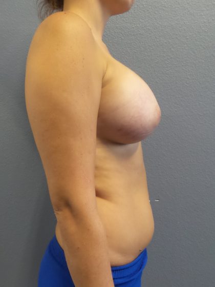 Breast Augmentation Before & After Patient #1693