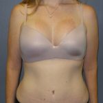 Abdominoplasty Before & After Patient #2138