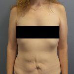 Abdominoplasty Before & After Patient #2138