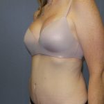 Abdominoplasty Before & After Patient #2138